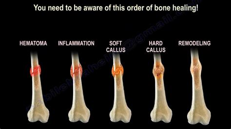 fear and hunger how to cure broken bones|How do i heal broken bone bro : r/FearAndHunger .